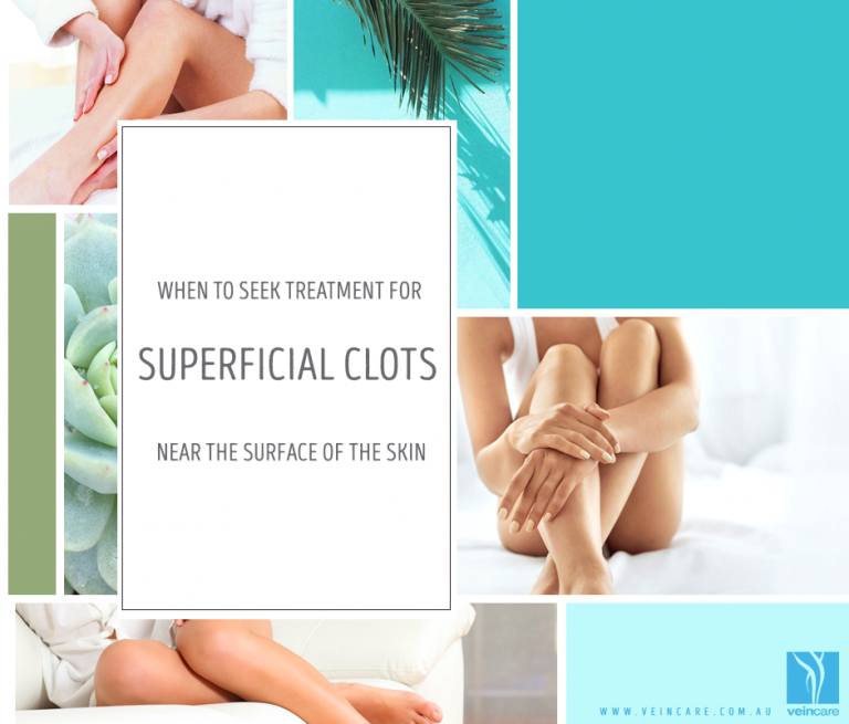 treating-superficial-clots-near-the-skin-surface-vein-care