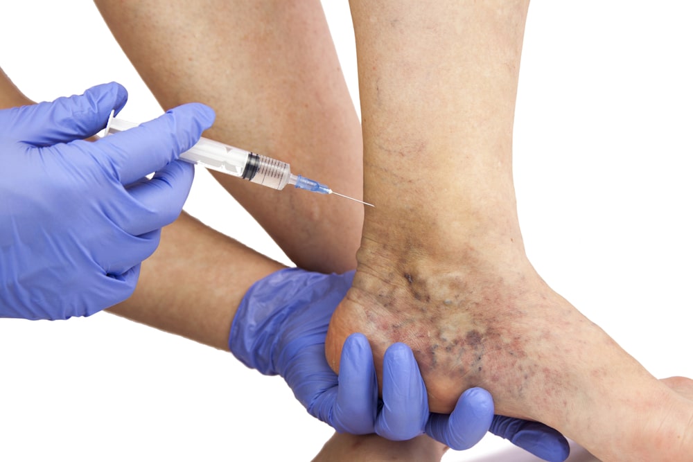 Treatment for Spider Veins in Melbourne