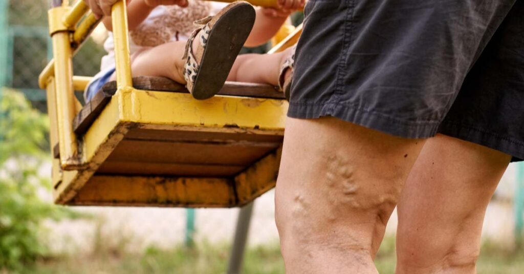 Best ways to prevent varicose veins in Australia