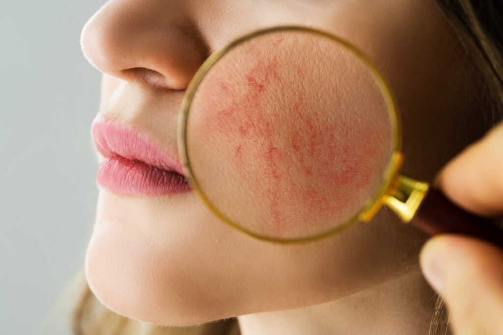doctor monitoring Rosacea Face Skin Problem with magnifying glass
