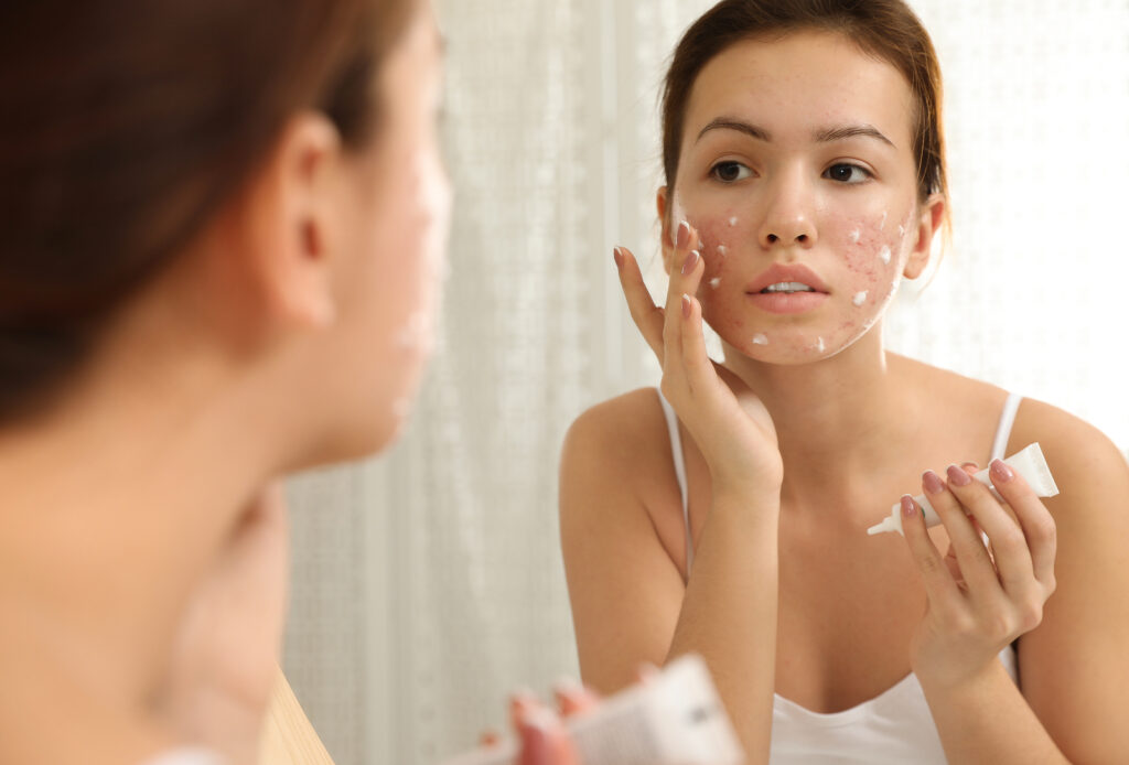 Women applying cream on her Rosacea cheeks
