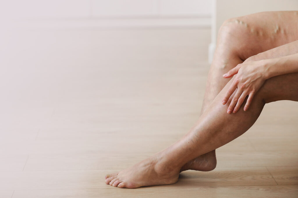 Painful Bulging veins on womans legs