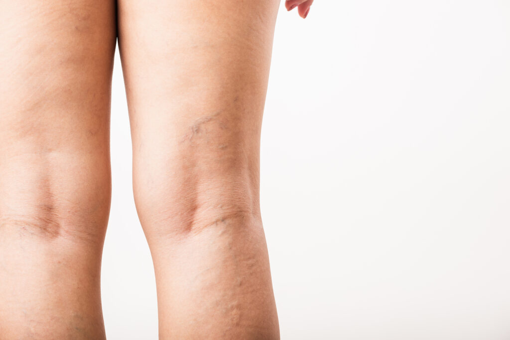 Close up image of women having spider vein on her leg
