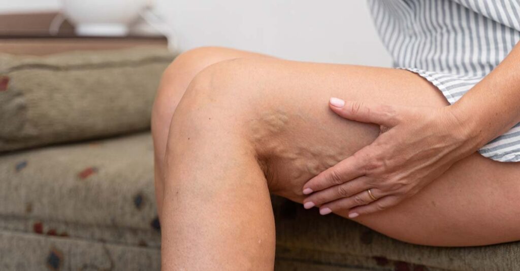 Sitting Position for Varicose Veins