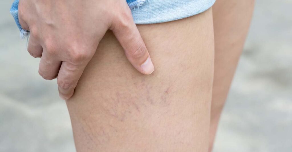 Varicose veins on the skin of leg