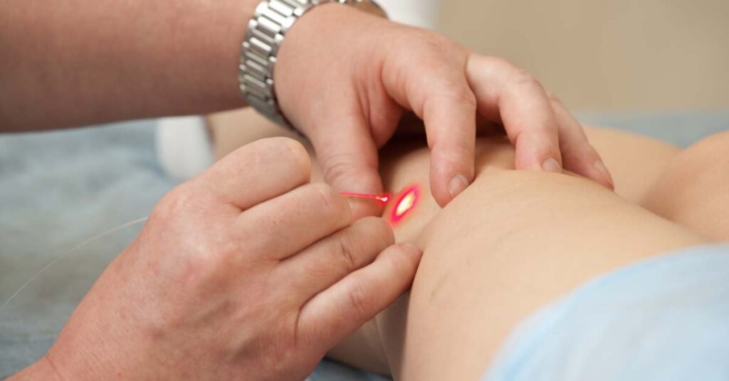 Varicose laser treatment on legs in Melbourne