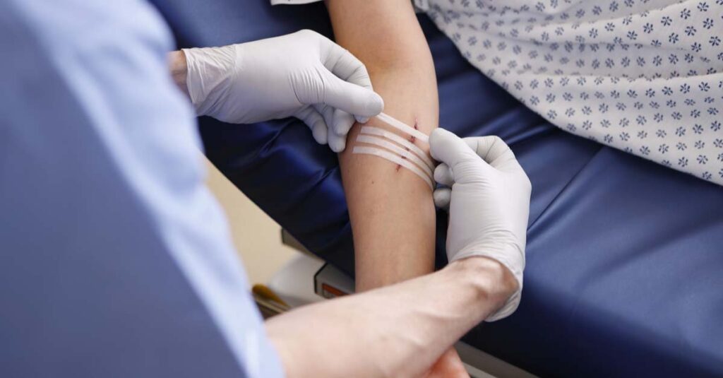 Ambulatory Phlebectomy for Varicose Veins Arms