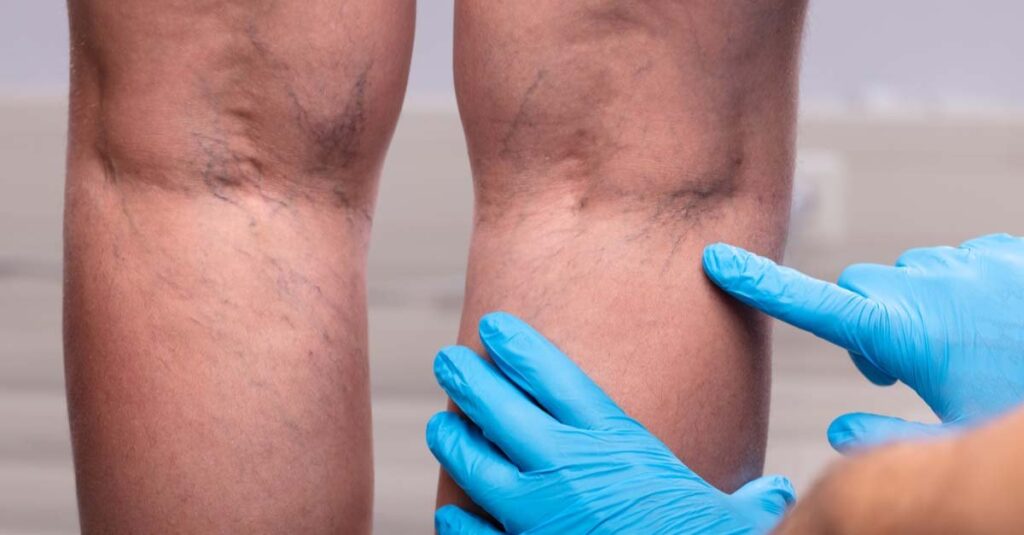 Medic With Blue Latex Surgical Gloves Touching Varicose Veins On Patient's Leg