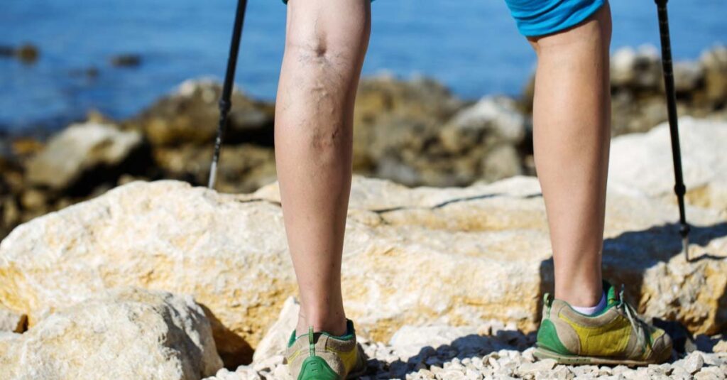 : Varicose veins on leg walking using trekking poles