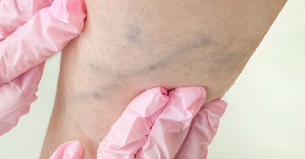 Examination of varicose veins on legs