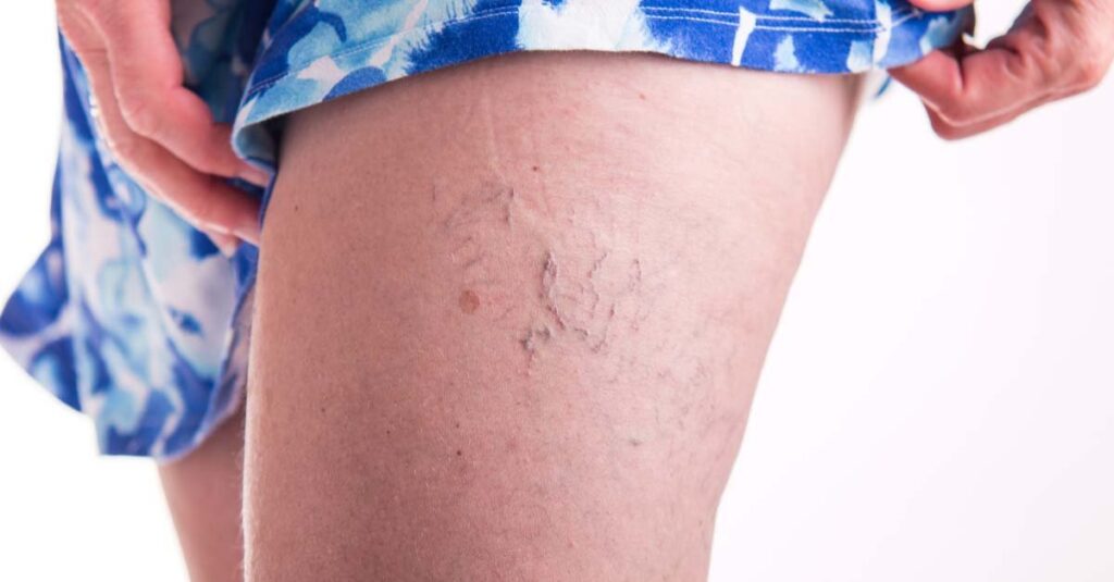 Human spider veins on the legs