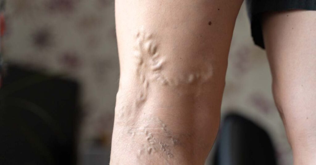 Varicose veins on legs indoors. Vascular health problem.