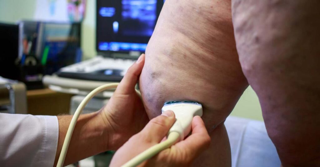 Ultrasound examination of varicose veins