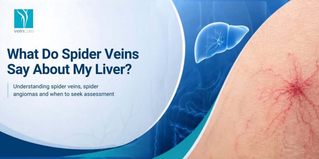 What Do Spider Veins Say About My Liver?