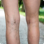 Deep Vein Thrombosis Treatment in Melbourne