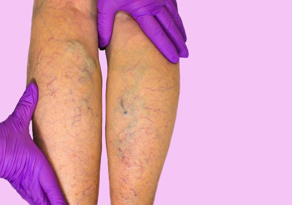Close-up of legs with varicose veins and a purple-gloved hand.