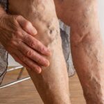 Treatment for Deep Vein Thrombosis in Melbourne