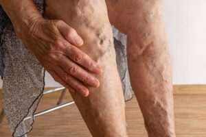 Deep Vein Thrombosis Symptoms: What to Look For