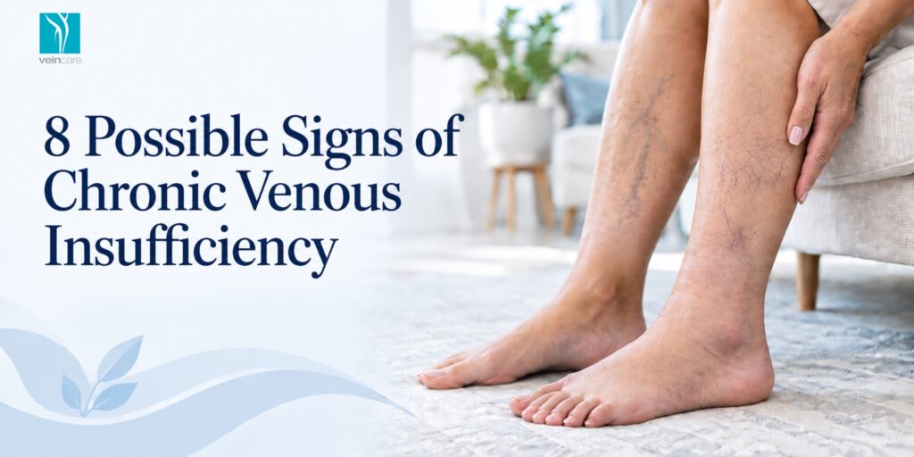 8 Possible Signs of Chronic Venous Insufficiency