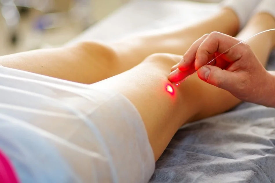 Ease Varicose Vein Pain Comfortably in Melbourne