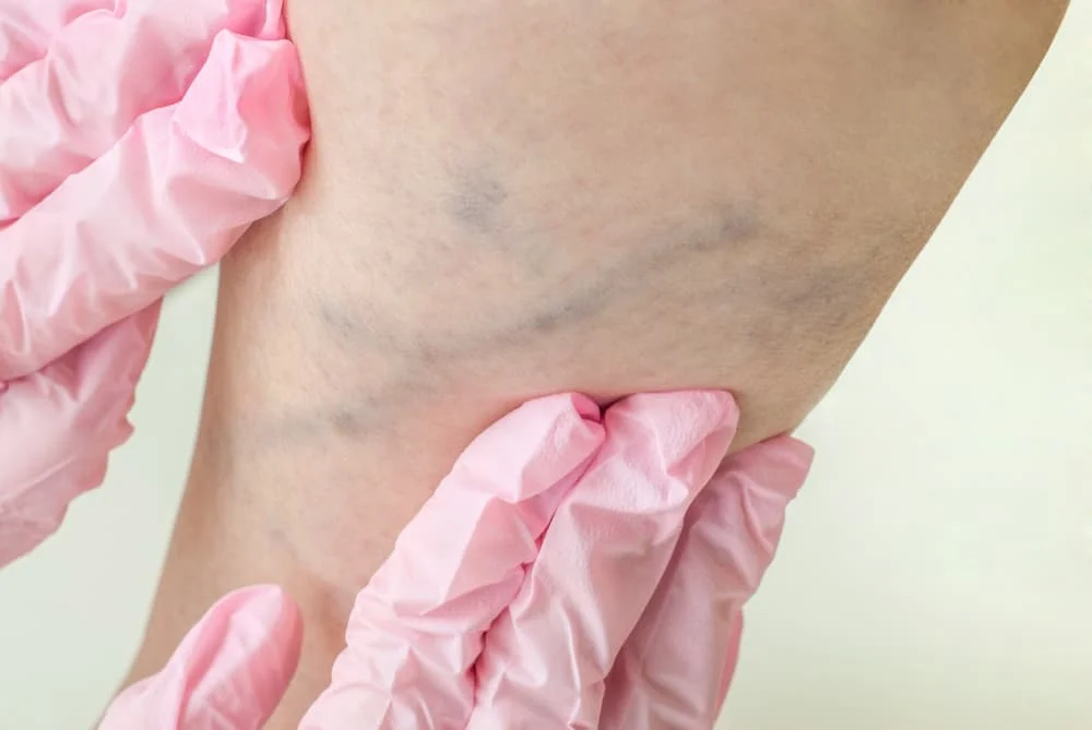 Examination of varicose veins on a woman legs by Vein Care