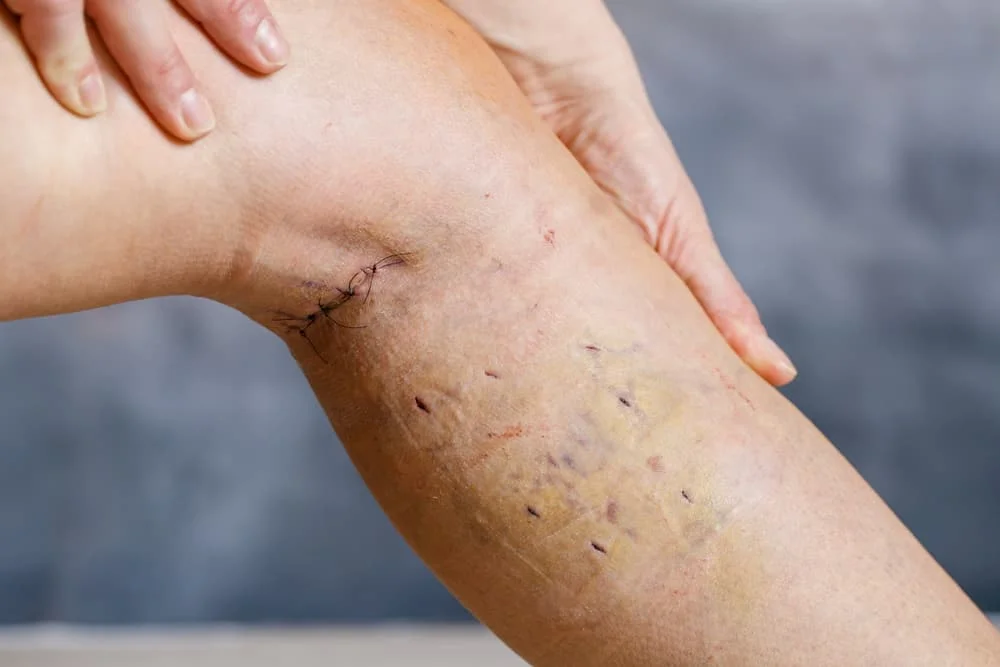 Womans leg after varicose vein surgery, with visible surgical sutures (stitches), wounds on her leg. Curative treatment, aesthetic procedures, thrombosis prevention and senior health care concept.